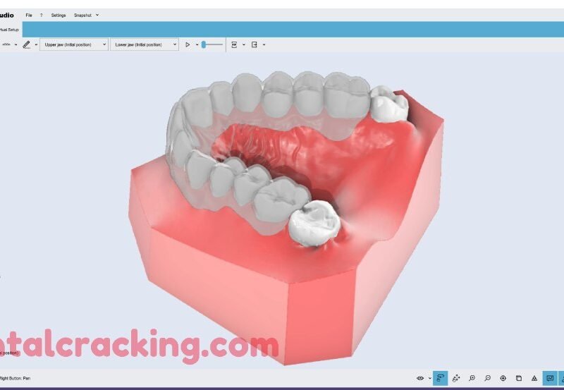 Hyperdent v9.4.3 crack